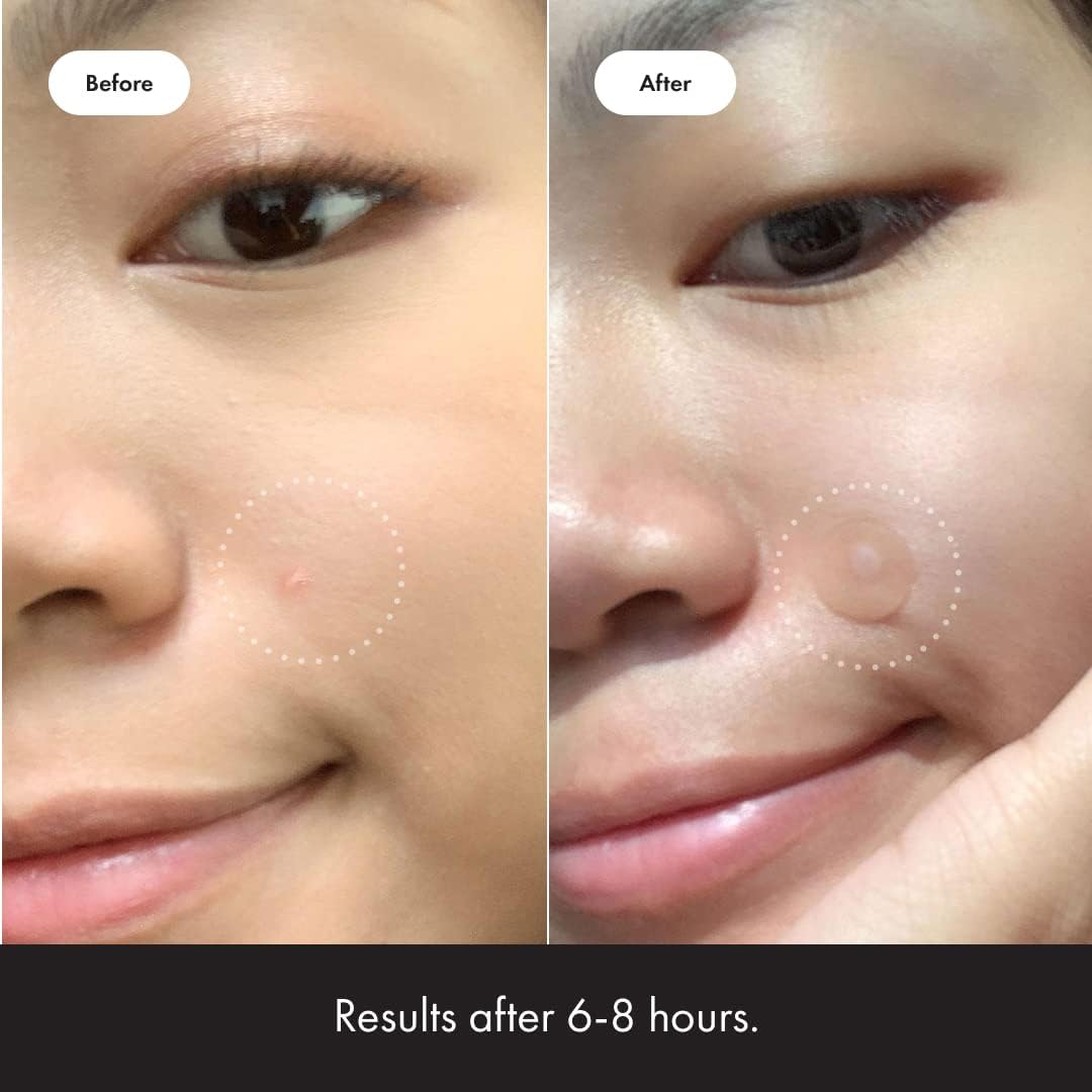 mighty patch original hydrocolloid acne pimple patch spot treatment (36ct) for.