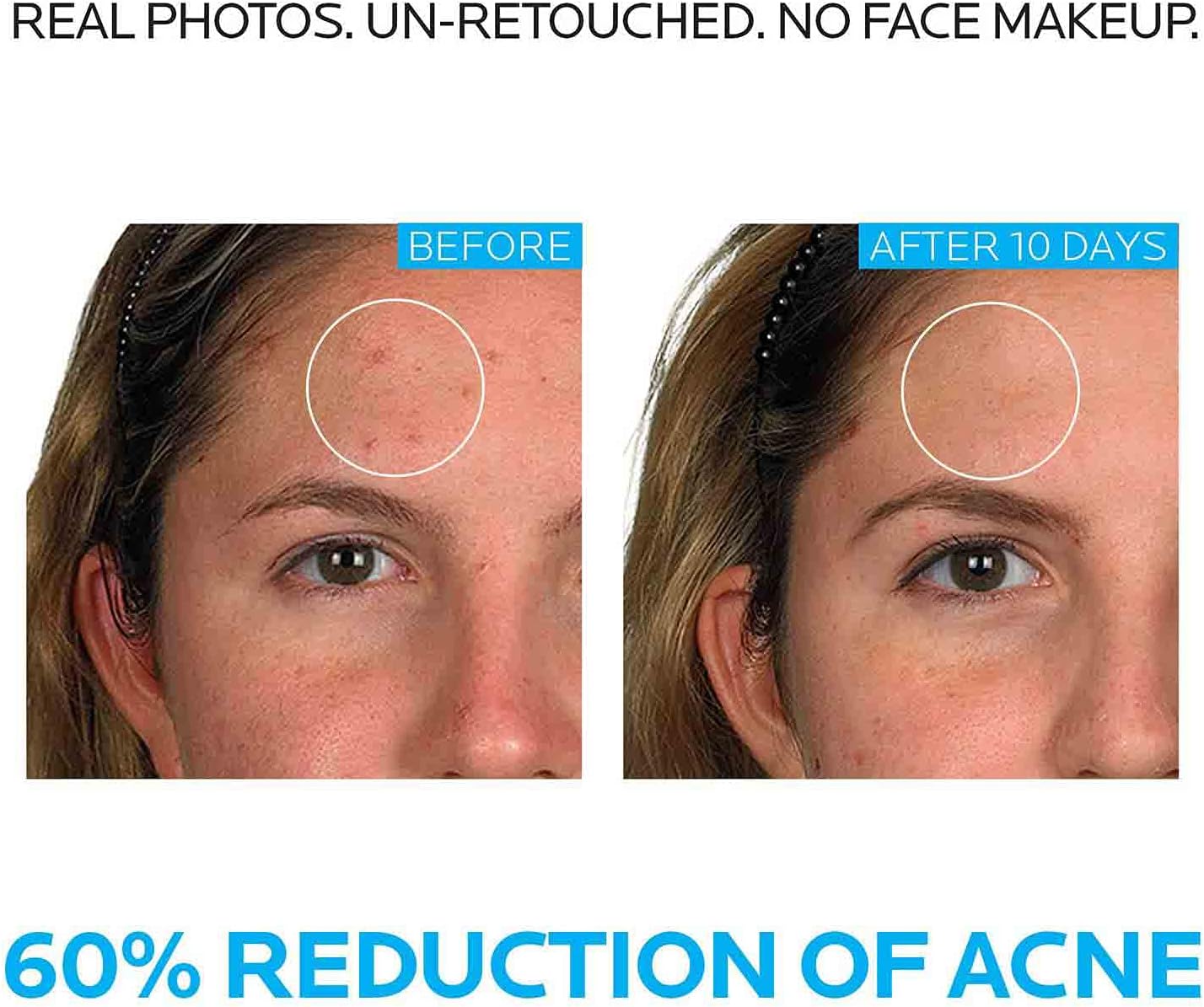 la roche posay effaclar dermatological 3 step acne treatment system, salicylic acid acne cleanser, pore refining toner, and benzoyl peroxide acne spot treatment for sensitive skin, 2 month supply