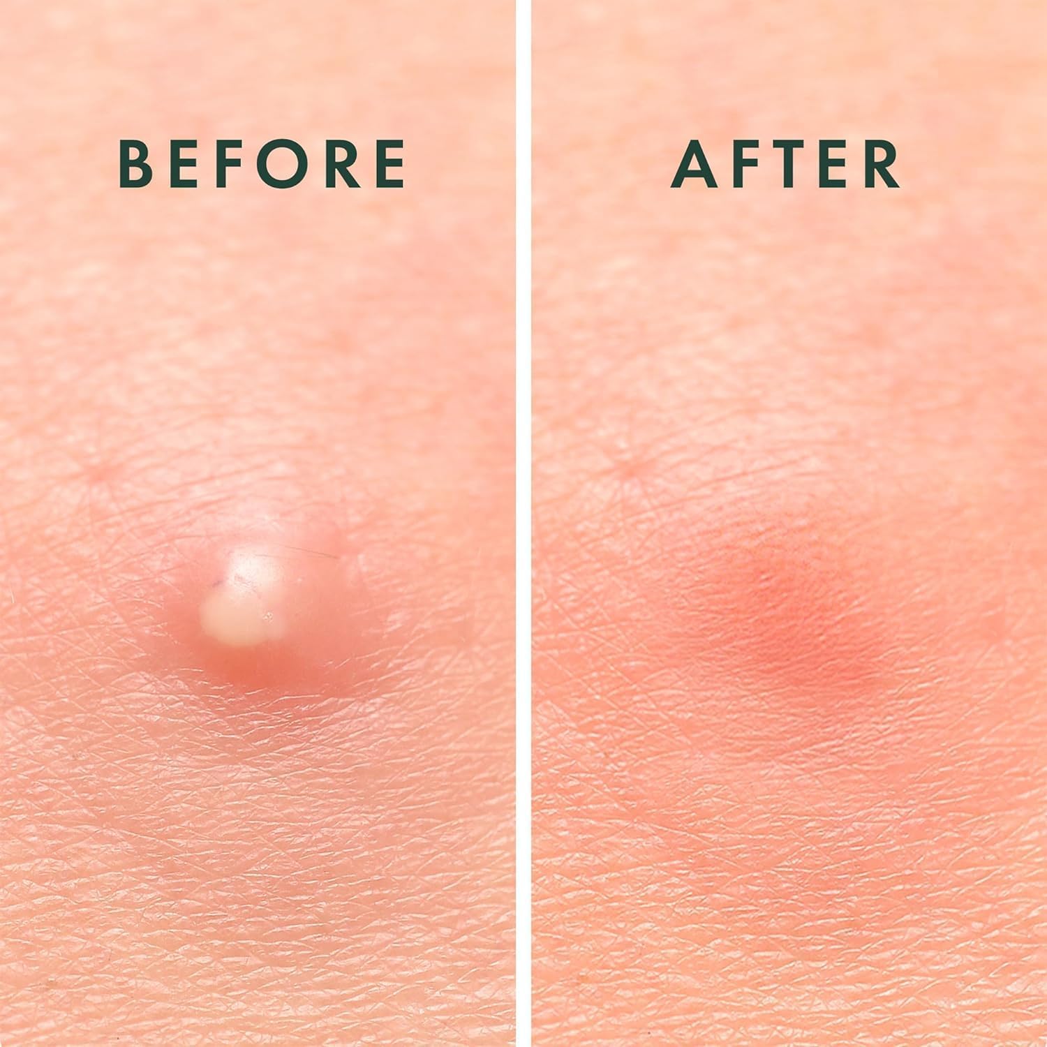 reliable arc 108 pcs hydrocolloiod pimple patches with tree tea oil acne dots / pimple / zit patches for face skin care gift set (packaging may vary)