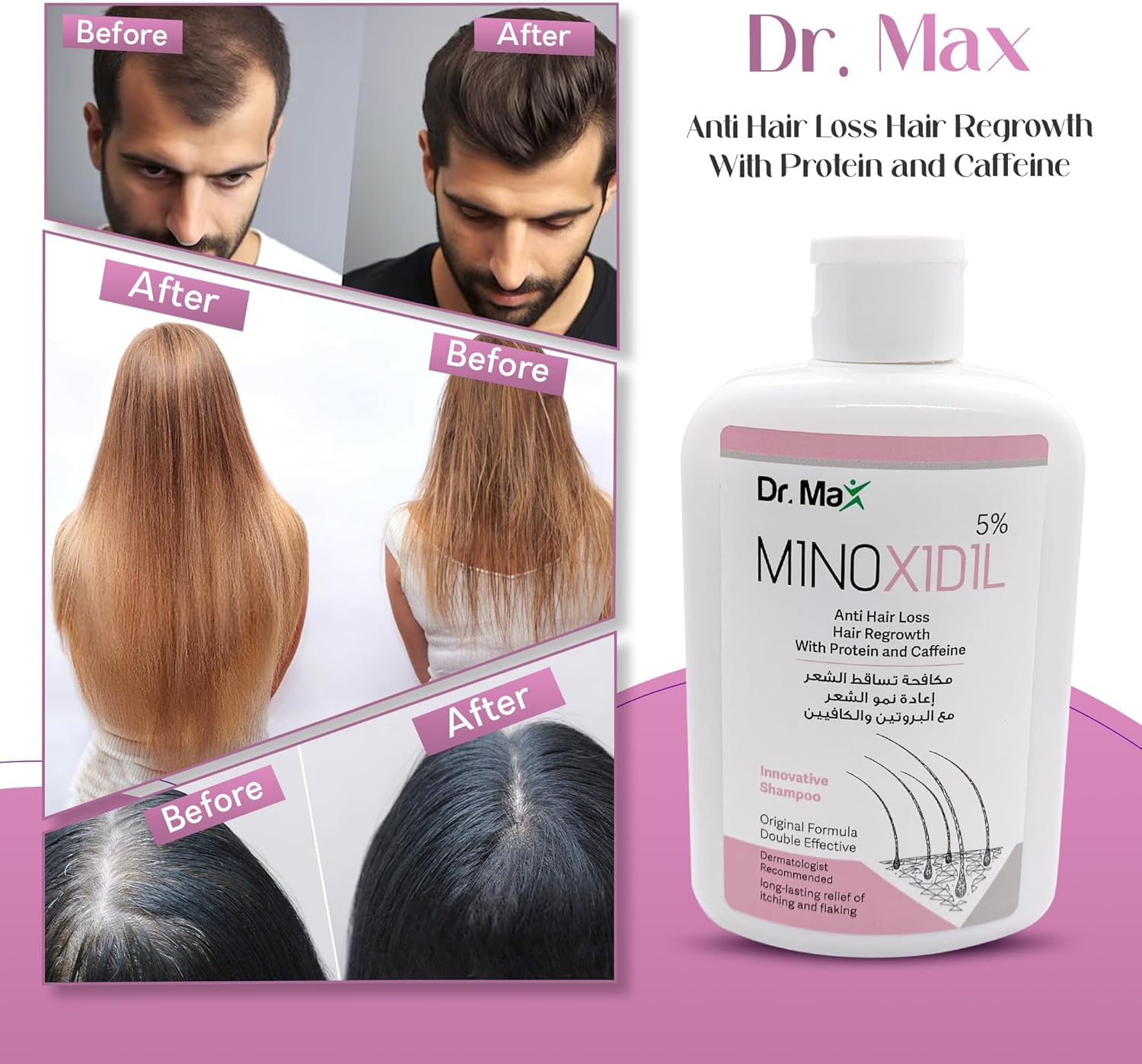 dr max minoxidil 5% anti hair loss shampoo, hair regrowth with protein caffeine long lasting relife of itching and flaking