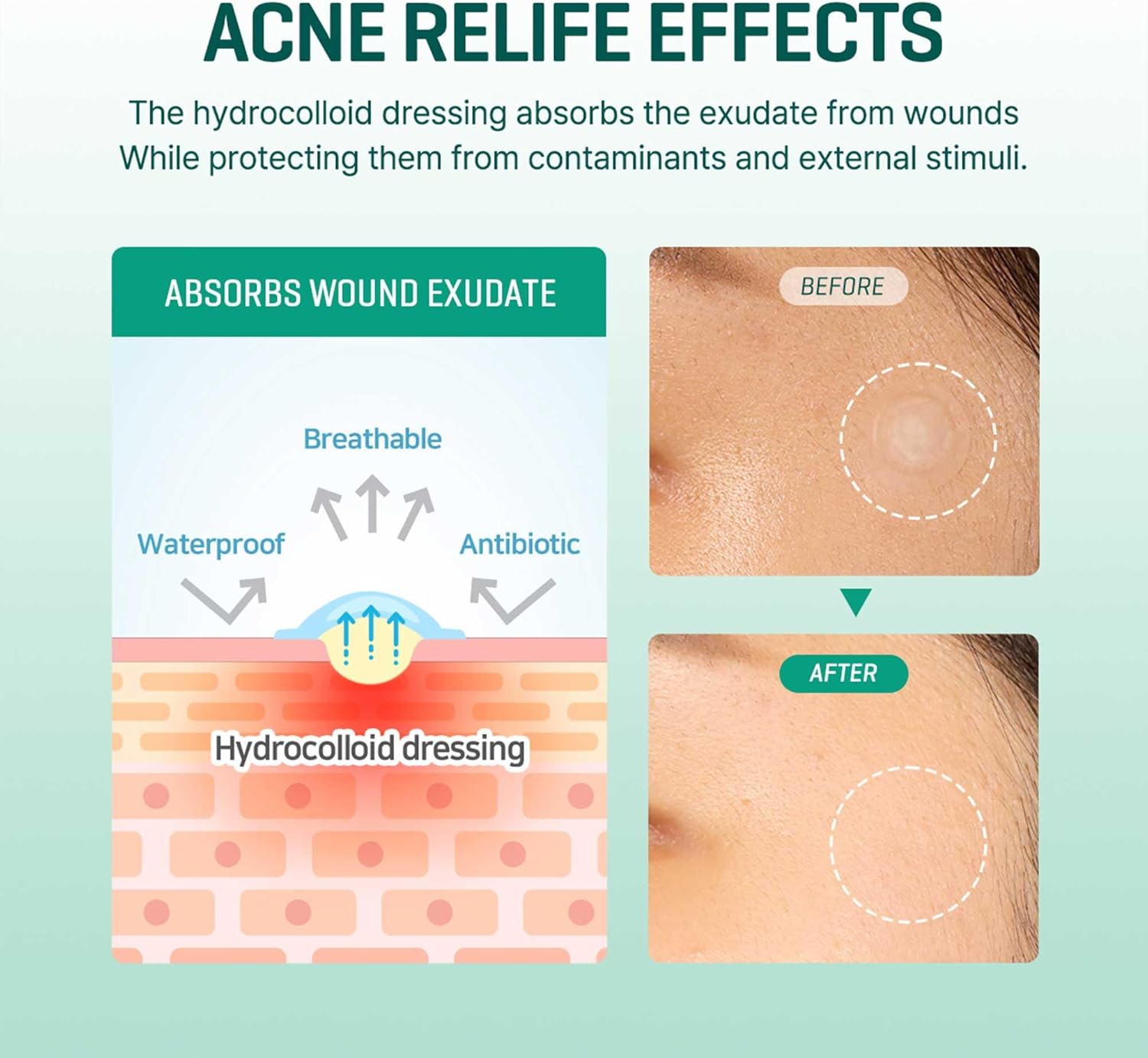 some by mi 30 days miracle clear spot patch | 18 counts, 2 size(10mm 9counts, 12mm 9counts) | invisible hydrocolloid skin trouble & pimple patch with no irritation | pack of 1